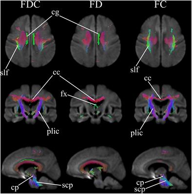 Fixel-Based Analysis Effectively Identifies White Matter Tract Degeneration in Huntington’s Disease